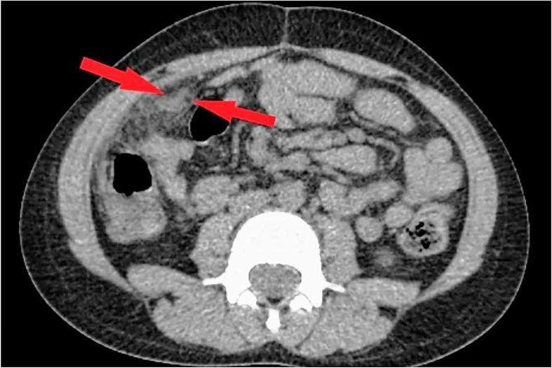 Epiploic appendagitis: Not so unusual cause of paediatric abdominal pain