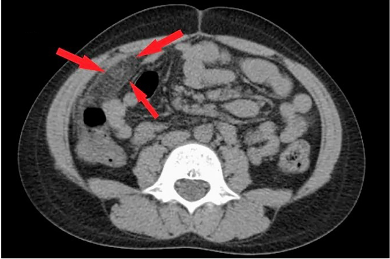 Epiploic appendagitis: Not so unusual cause of paediatric abdominal pain