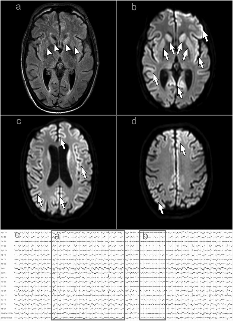 Creutzfeldt-Jakob disease after COVID-19: infection-induced prion protein misfolding? A case report.