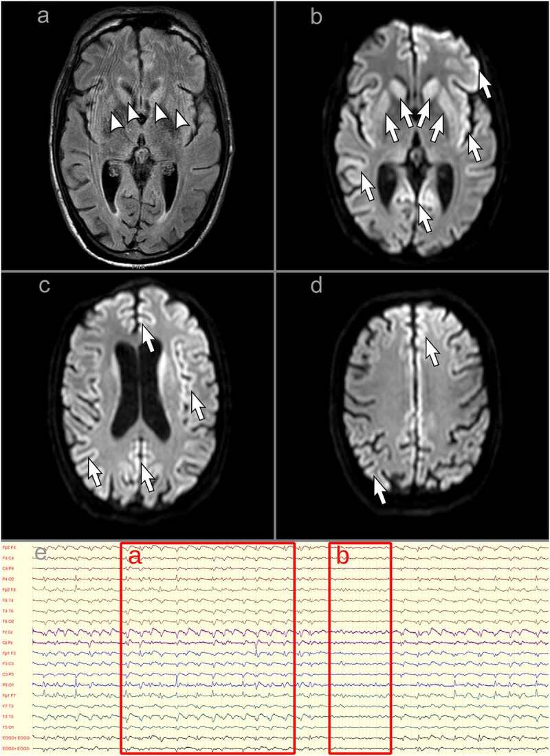 Creutzfeldt-Jakob disease after COVID-19: infection-induced prion protein misfolding? A case report.