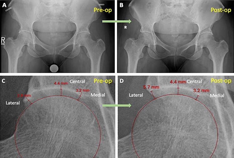 It's not arthritis! Resolution of the illusion of joint space narrowing with acetabuloplasty and labral reconstruction for the calcified labrum.