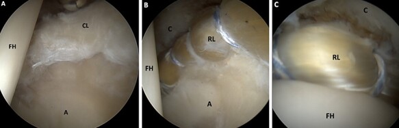 It's not arthritis! Resolution of the illusion of joint space narrowing with acetabuloplasty and labral reconstruction for the calcified labrum.