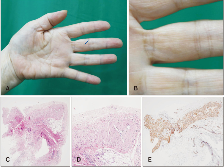 Myopericytoma of the Finger: A Case Report and Literature Review.