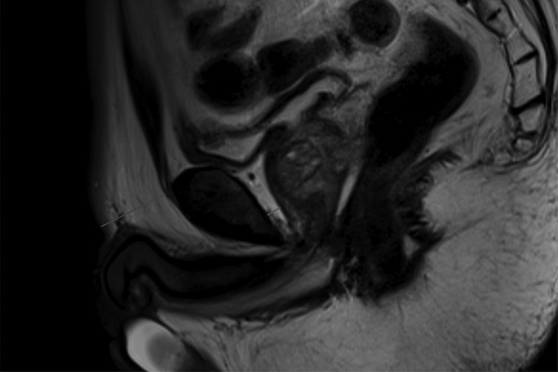 MRI-measured adipose features as predictive factors for detection of prostate cancer in males undergoing systematic prostate biopsy: a retrospective study based on a Chinese population.