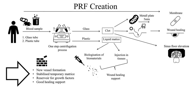 Platelet-Rich Fibrin in Oral Surgery and Implantology: A Narrative Review.