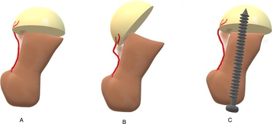 Is there a role for controlled repositioning and mini-open primary osteoplasty in the management of unstable slipped capital femoral epiphysis?