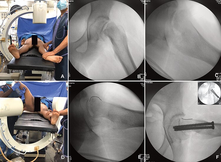 Is there a role for controlled repositioning and mini-open primary osteoplasty in the management of unstable slipped capital femoral epiphysis?