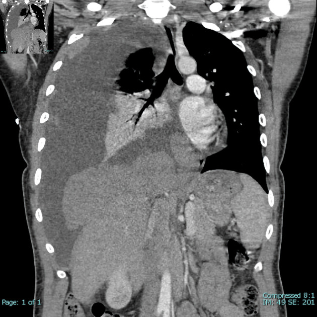 Thymoma With Triple Threat: Pure Red Cell Aplasia, Autoimmune Hemolytic Anemia, and T-Cell Large Granular Lymphocytic Leukemia.