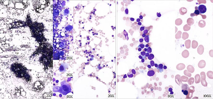 Thymoma With Triple Threat: Pure Red Cell Aplasia, Autoimmune Hemolytic Anemia, and T-Cell Large Granular Lymphocytic Leukemia.