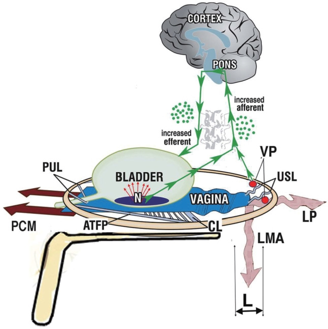 Interstitial Cystitis: A Consequence of Weakened Uterosacral Ligaments Failing to Support Visceral Plexuses and Bladder Stretch Receptors, and Therefore Potentially Curable?