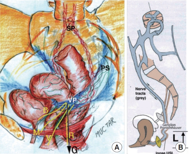 Interstitial Cystitis: A Consequence of Weakened Uterosacral Ligaments Failing to Support Visceral Plexuses and Bladder Stretch Receptors, and Therefore Potentially Curable?