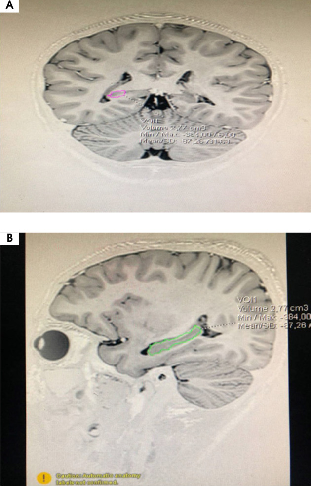 Intellectual disability as a comorbidity in Tourette syndrome: a case report.