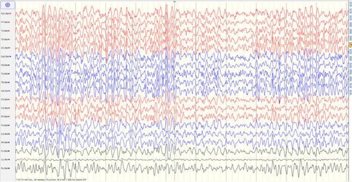 Intellectual disability as a comorbidity in Tourette syndrome: a case report.