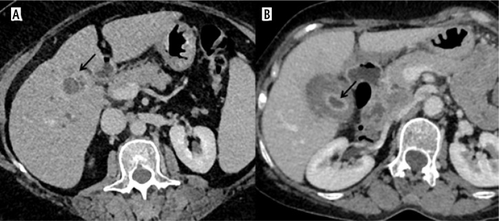 Imaging patterns of wall thickening type of gallbladder cancer.