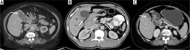 Imaging patterns of wall thickening type of gallbladder cancer.