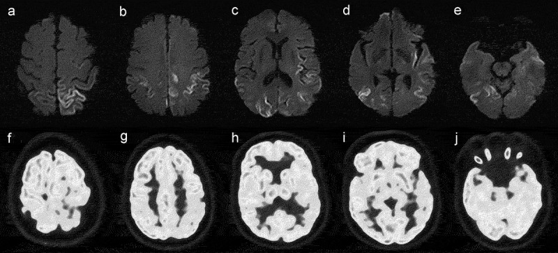 18F-FP-CIT PET/CT in a case of probable sporadic Creutzfeldt-Jakob disease with parkinsonism as initial symptom.