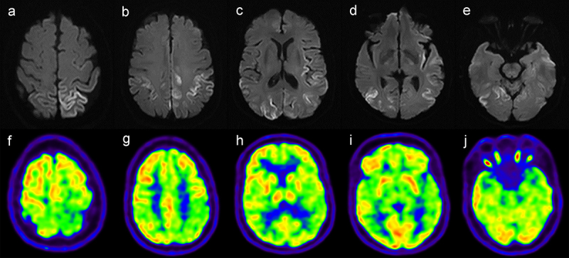 18F-FP-CIT PET/CT in a case of probable sporadic Creutzfeldt-Jakob disease with parkinsonism as initial symptom.