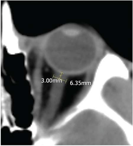 The Clinical Importance of Optic Nerve Sheath Diameter in Patients with Traumatic Brain Injury: Preliminary Report.