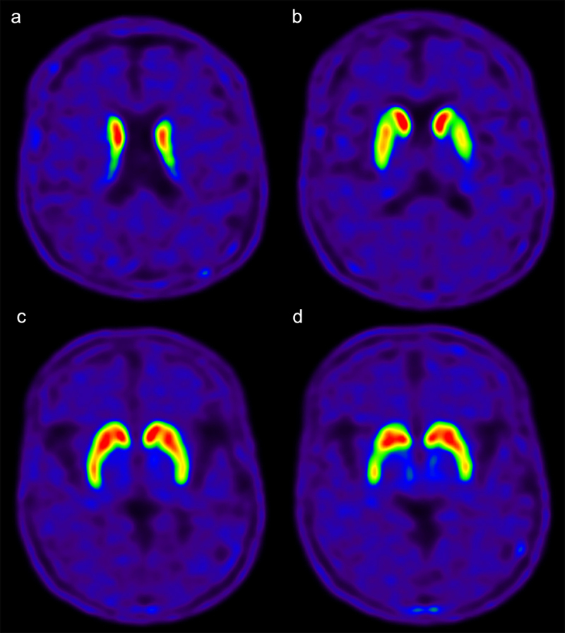 18F-FP-CIT PET/CT in a case of probable sporadic Creutzfeldt-Jakob disease with parkinsonism as initial symptom.