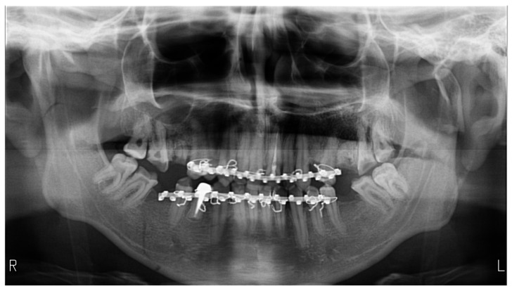 Post-Traumatic-Related Technical Errors in Orthopantomographic Imaging.