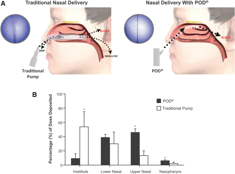 Delivery of Dihydroergotamine Mesylate to the Upper Nasal Space for the Acute Treatment of Migraine: Technology in Action.