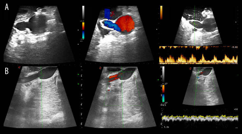 Modification of Venous Outflow to Avoid Thrombotic Graft Failure in Pancreas Transplantation.