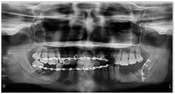 Post-Traumatic-Related Technical Errors in Orthopantomographic Imaging.