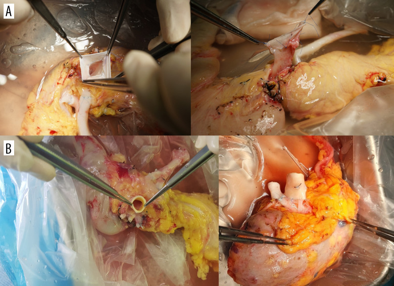 Modification of Venous Outflow to Avoid Thrombotic Graft Failure in Pancreas Transplantation.