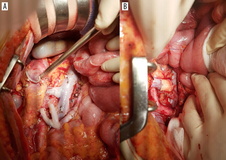 Modification of Venous Outflow to Avoid Thrombotic Graft Failure in Pancreas Transplantation.