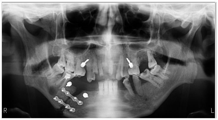 Post-Traumatic-Related Technical Errors in Orthopantomographic Imaging.