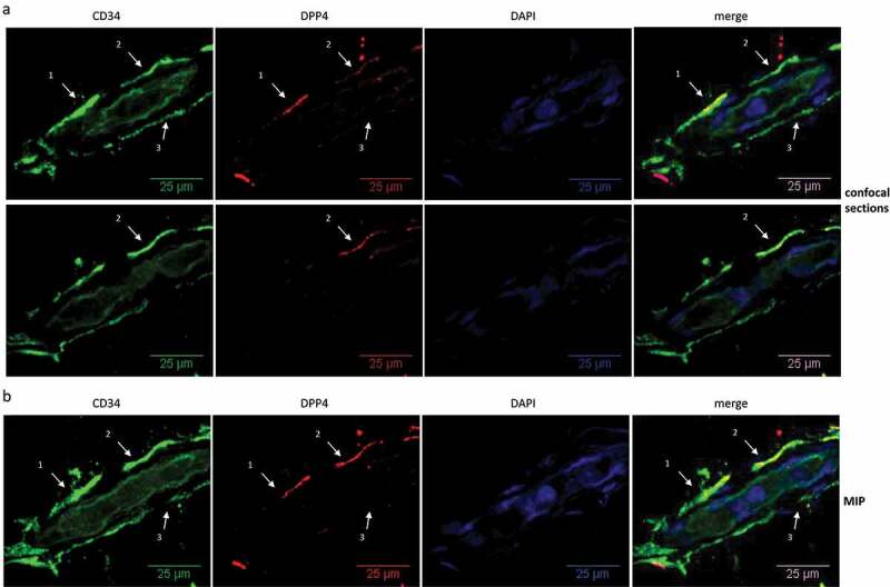 Dipeptidyl peptidase-4 cell surface expression marks an abundant adipose stem/progenitor cell population with high stemness in human white adipose tissue.