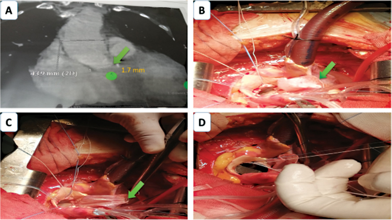 Outcomes Post-Nick's Aortic Root Enlargement Technique: Single-Center Experience.