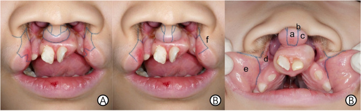 Bilateral cleft lip repair by new trending method: a case report.