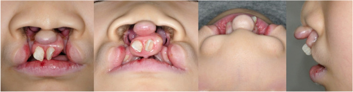 Bilateral cleft lip repair by new trending method: a case report.