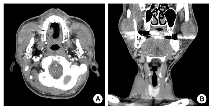 Current concepts of Kimura disease: pathophysiology and evolution of treatment.