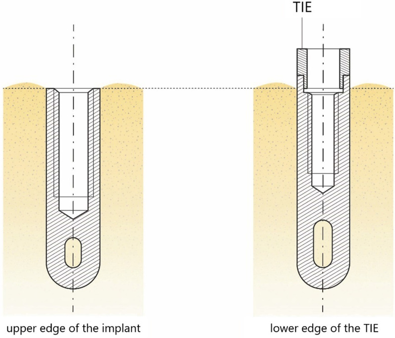 Long-term outcome of the IMZ implant system: a retrospective clinical study with a follow-up between 23 and 34 years.