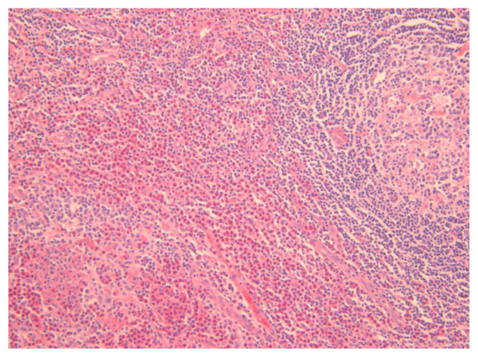 Current concepts of Kimura disease: pathophysiology and evolution of treatment.