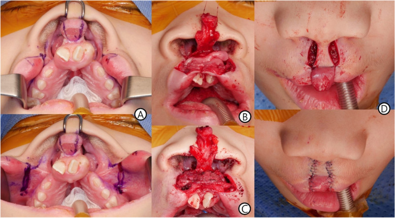 Bilateral cleft lip repair by new trending method: a case report.