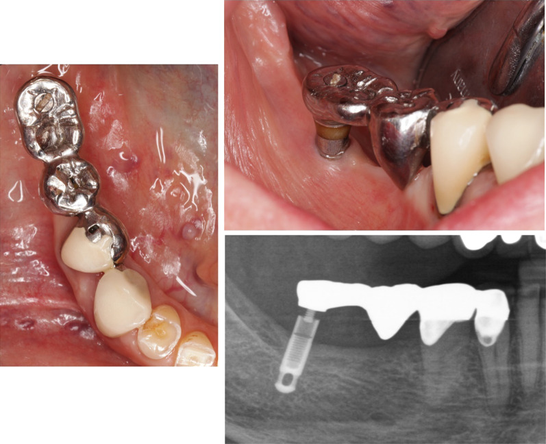 Long-term outcome of the IMZ implant system: a retrospective clinical study with a follow-up between 23 and 34 years.