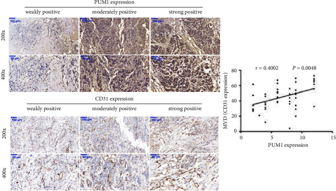 Pumilio RNA-Binding Family Member 1 Plays a Promoting Role on Pancreatic Cancer Angiogenesis.