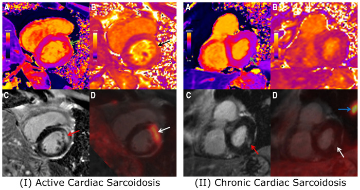 Recent advances in PET-MRI for cardiac sarcoidosis.