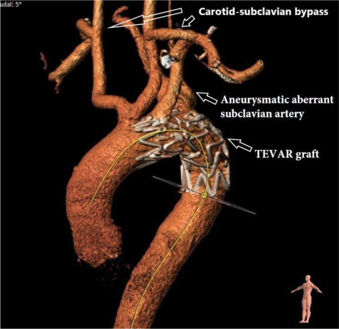 Three Different Strategies for Repair of Symptomatic or Aneurysmatic Aberrant Right Subclavian Arteries.