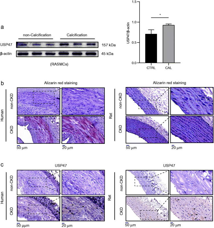 Ubiquitin-specific protease 47 is associated with vascular calcification in chronic kidney disease by regulating osteogenic transdifferentiation of vascular smooth muscle cells.