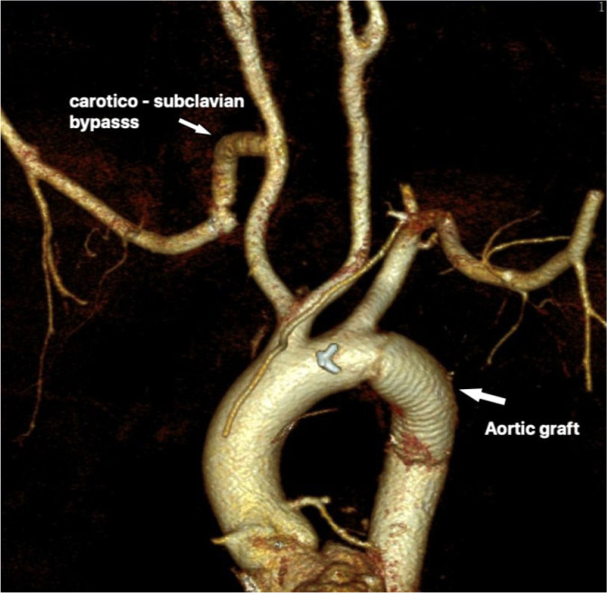 Three Different Strategies for Repair of Symptomatic or Aneurysmatic Aberrant Right Subclavian Arteries.
