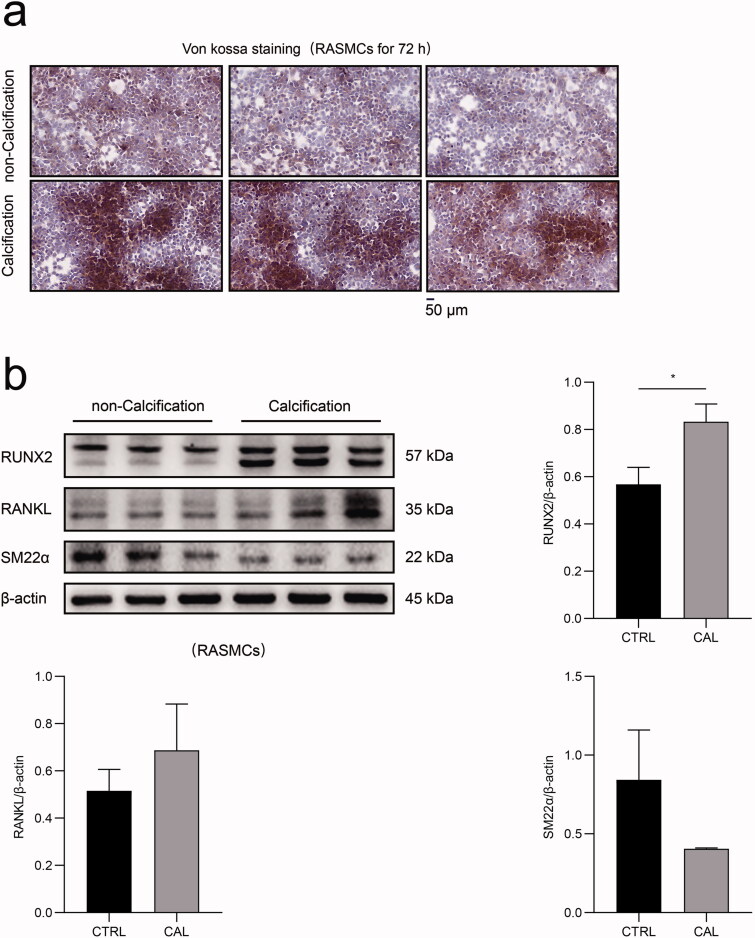 Ubiquitin-specific protease 47 is associated with vascular calcification in chronic kidney disease by regulating osteogenic transdifferentiation of vascular smooth muscle cells.