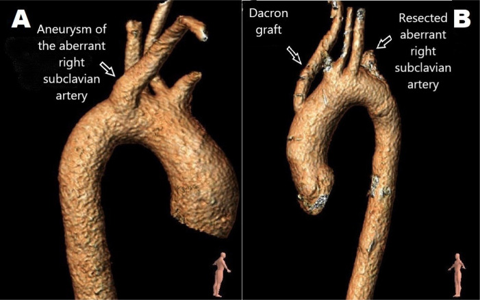 Three Different Strategies for Repair of Symptomatic or Aneurysmatic Aberrant Right Subclavian Arteries.