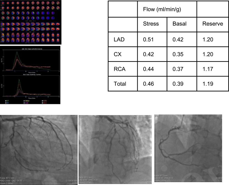 Improved detection of coronary artery disease by CZT regional coronary blood flow evaluation.