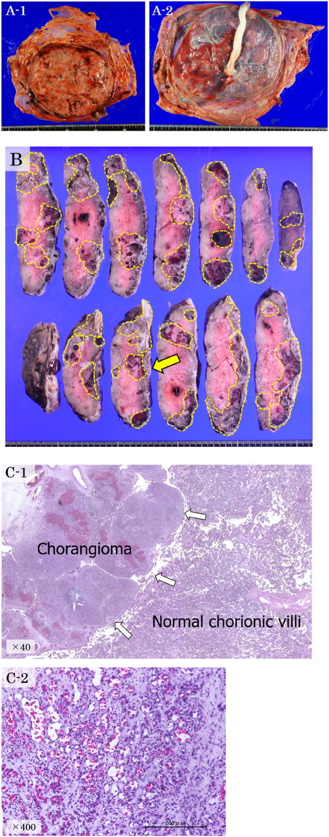 A case of placental multiple giant chorangioma leading to neonatal death from fetal hydrops.