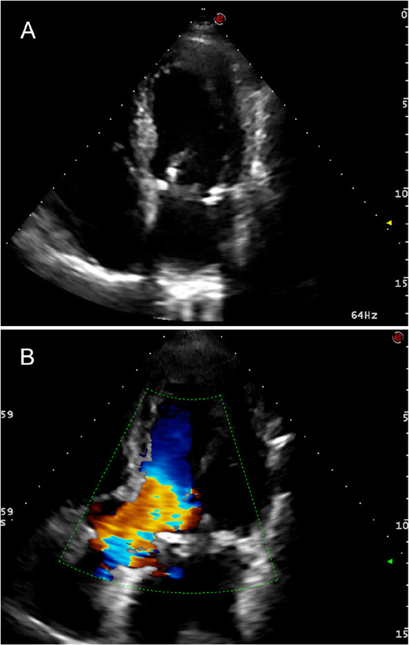 A Surgical Technique to Preserve the Subvalvular Apparatus in Patients Undergoing Mitral Valve Replacement for Severe Ischemic Regurgitation.