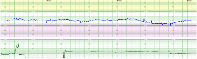A case of placental multiple giant chorangioma leading to neonatal death from fetal hydrops.